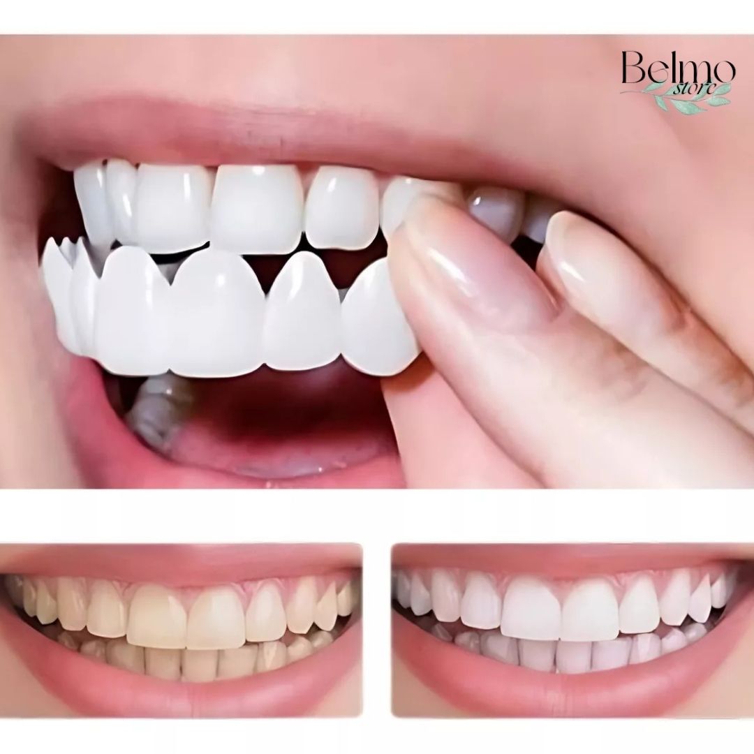 SMILELIFT® - PAR CARILLA DE DIENTES